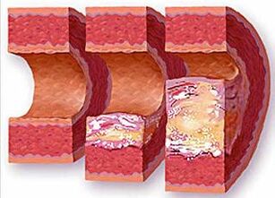 Stages of atherosclerotic plaque formation in a vessel with high blood pressure